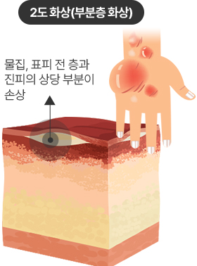 2도 화상(부분층 화상)